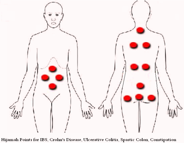 Hijamah for IBS, Ulcerative Colitis & Crohn's Disease